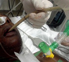 Extubation sur tube de Cook