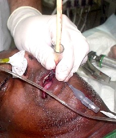 R-intubation sur tube de Cook