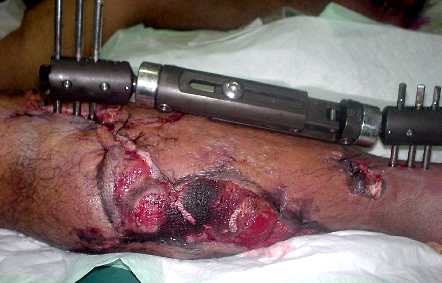 Nécrose de jambe sur accident de moto (BAG 2005)