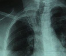 Lobite tuberculeuse du sommet droit : attraction trachale et pachypleuryte (photo: BAG)