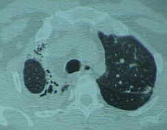 Lobite tuberculeuse du sommet droit : cavernes et pachypleuryte (photo: BAG)