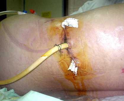 Drainage simple sans laparotomie d'une fistule du colon, après drainage percutané du rein gauche pour lithiase (photo : BAG 2005)