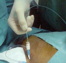 Introductiion de la sonde de stimulation dans la veine centale
