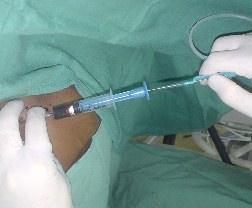 Introduction du mandrin metallique souple