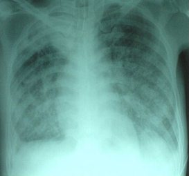 Sida et miliaire tuberculeuse rapidement mortelle : 12 CD 4 (BAG 2003)