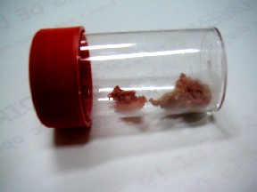 Extraction des morceaux de viande : aprs fibroscopie (photo P. Schlossmacher 2004)